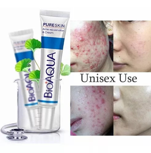 Bioaqua Crema Removedora De Acne Original Pure Skin Removal