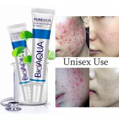 Bioaqua Crema Removedora De Acne Original Pure Skin Removal